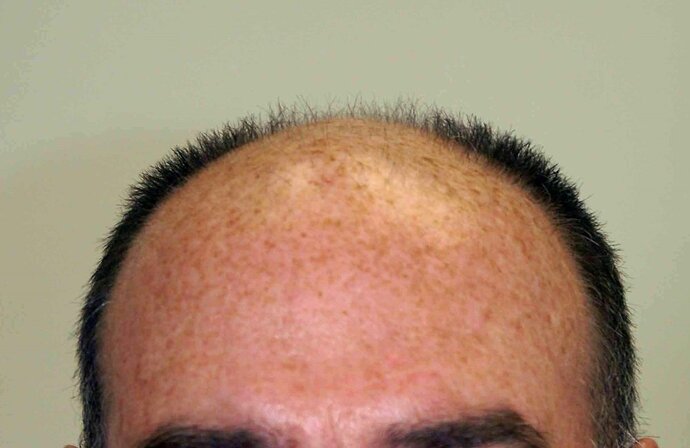 Dr B Farjo 2000-2023 Patient using both FUT and FUE, photo