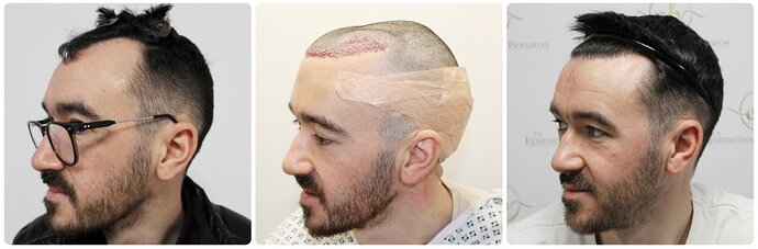 Dr Bonaros, Glasgow, UK / 1816 FUE grafts / 0-12 Months photo