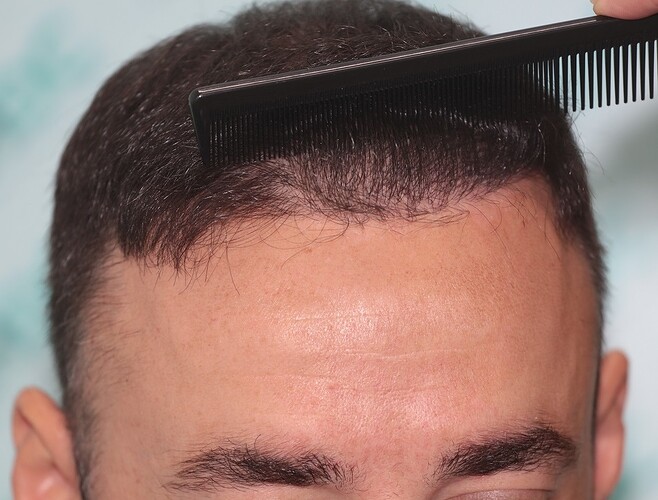 Two FUE Surgeries Totaling 6560 Grafts – HDC Hair Clinic photo
