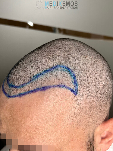 CASE DR. LUPANZULA: 2538 UFS, FUE - TEMPLES-HAIRLINE/CROWN photo