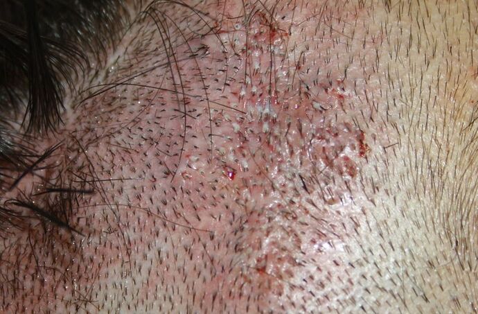 Dr. Teresa Meyer, BHR Clinic, Spain, 234 FUE to scar 0 - 5 months photo