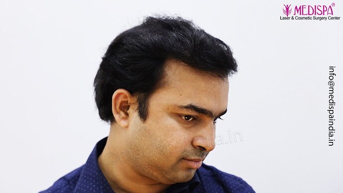 Dr. Suneet Soni - 5000 Grafts, Combine FUT + FUE + Beard Technique, NW-V photo