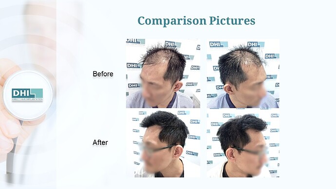 DHI India | NW 5 | 5,319 Grafts | 7-Months DHI Hair Transplant Results photo