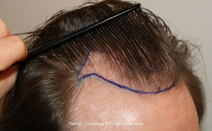 Case performed by Dr. Feriduni – 3322 FU in 1 procedure photo