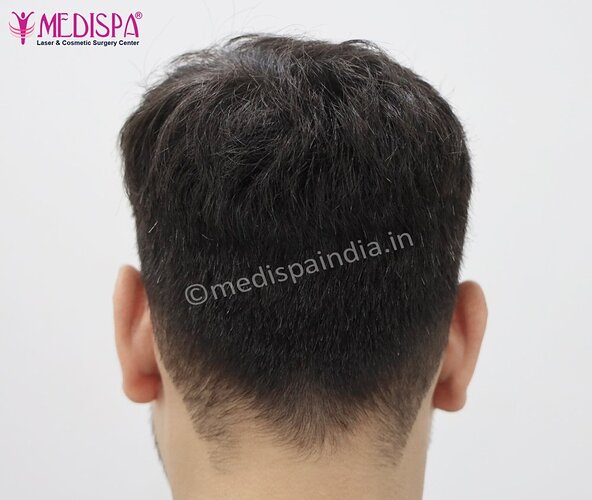 Dr. Suneet Soni - 2500 FUE Grafts, NW- III photo