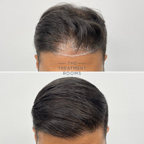 1411 Grafts Hairline and Crown Result- The Treatment Rooms London photo