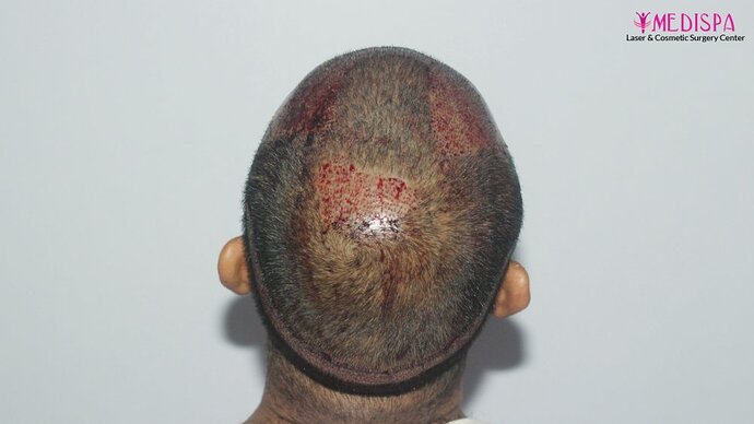 Dr. Suneet Soni - 4025 Grafts | 12-Month Result | Combination FUT + FUE photo