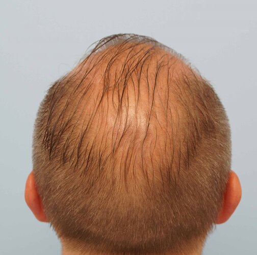 Dr B Farjo 1700g FUE (Front) photo
