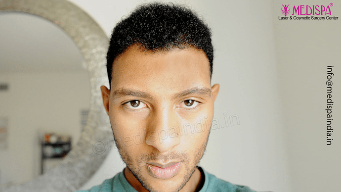 Dr. Suneet Soni - Afro Hair Transplant, 2 Sessions, 8355 Grafts, Combined FUT + FUE Technique, NW-VI, 5 Years Result photo