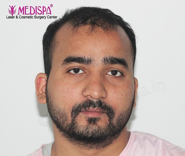 Dr. Suneet Soni - 4500 Grafts, Combine FUT + FUE + Beard Technique , NW- IV photo