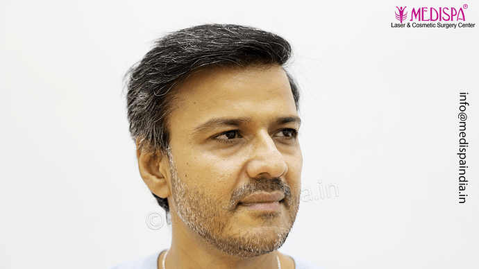 Dr. Suneet Soni - 4889 Grafts | 2.5 Years Result | Combination FUT + FUE + Beard photo