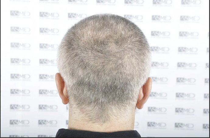 Asmed Clinic - FUE Hair Transplant - 5041 Grafts photo