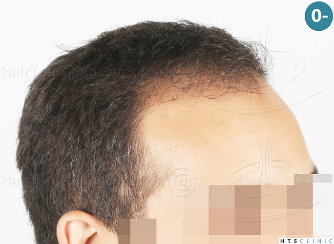 Dr Devroye + Dr Montesanti + Dr Jenard, HTS Clinic / 2018 FUE / Hairline & frontal area photo