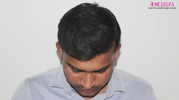 Dr. Suneet Soni - 5587 Grafts, Combine FUT + FUE + Beard Technique, NW : V-VI photo