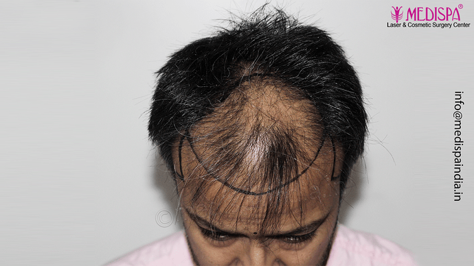 Dr. Suneet Soni - 4889 Grafts | 2.5 Years Result | Combination FUT + FUE + Beard photo