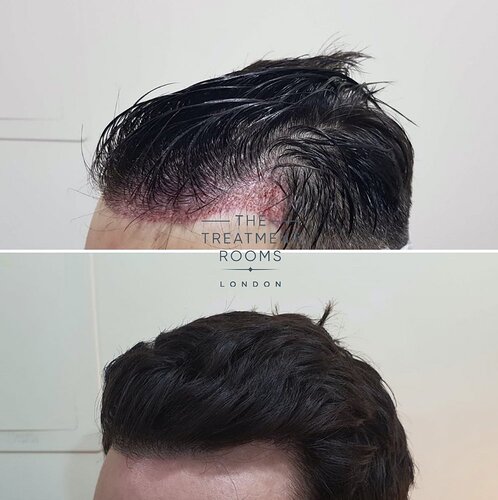 Hairline FUE hair transplant surgery photo