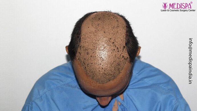 Dr. Suneet Soni - 4500 Grafts, Combine FUT + FUE Technique, NW-III photo