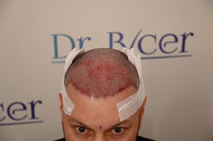 Ozlem Bicer MD-Hair Transplant-2910 Grafts FUE by micro-motor, 7. months result photo