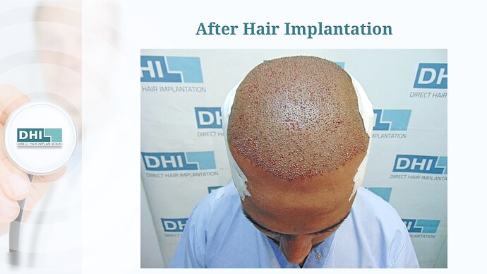DHI India™ | NW 6 | 4,473 Grafts | 1-Year Hair Transplant Result photo