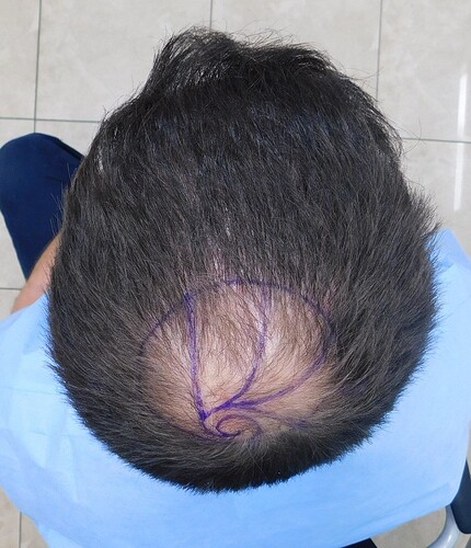 Result of FUE1 to front and top – Post op of Crown with 6055 Grafts – HDC Hair Clinic – Dr Christina photo