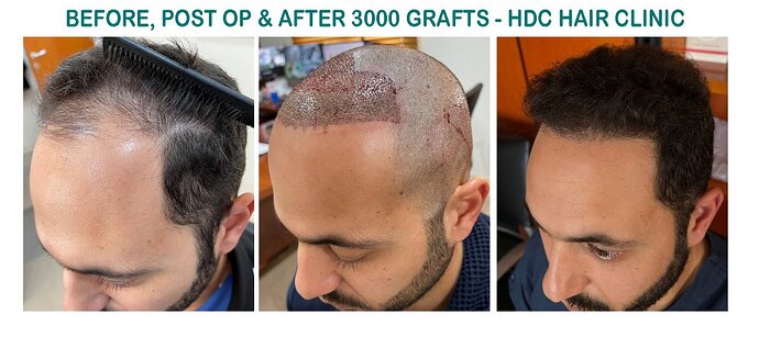 Result of 2 FUE Sessions For Total 5700 grafts - Front and Crown – HDC Hair Clinic photo