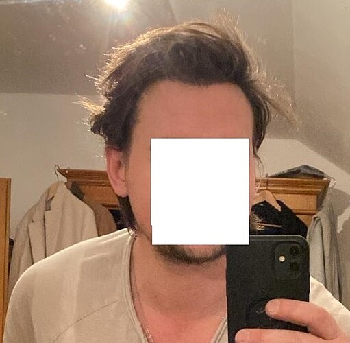 Hairline FUE Result for 2500 Grafts – 8 Months After – HDC Hair Clinic photo