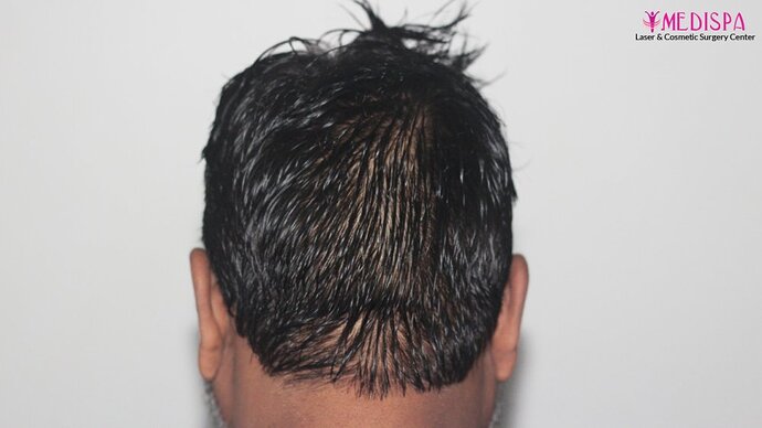 Dr. Suneet Soni - 4190 Grafts, Combine FUT + FUE + Beard Technique, NW- III photo