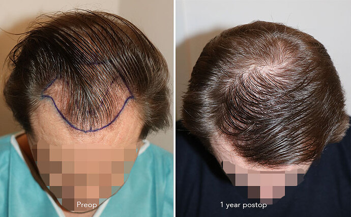 Case performed by Dr. Feriduni – 3322 FU in 1 procedure photo