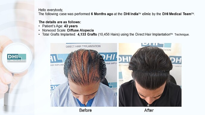 DHI India™ | 4,133 Grafts | Diffuse Alopecia | Full Coverage in 6 Months photo