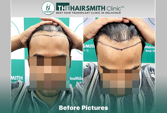 The HairSmith Clinic™ | NW Stage 3 | 2145 Grafts | 8 Months Hair Transplant Result photo