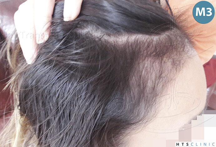 Dr. Jean Devroye, HTS Clinic / 3568 FUT (2695 + 873) / Female hairline restoration photo