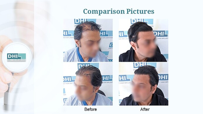 DHI India™ | 4,133 Grafts | Diffuse Alopecia | Full Coverage in 6 Months photo
