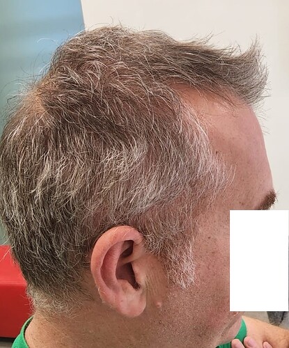 Result 3125 grafts – 10 months after – Top Coverage and Connecting top hair with side donor – HDC Hair Clinic – Dr Maras photo