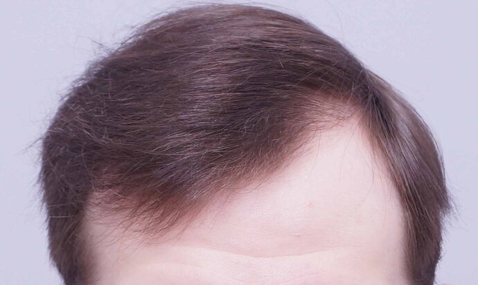 Dr B Farjo 1560g FUE (Frontal) photo
