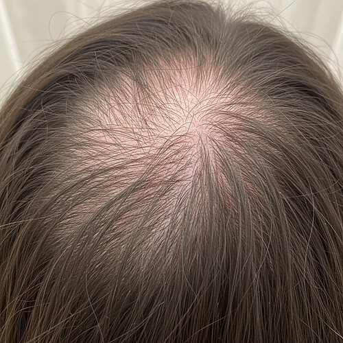 Scalp with diffuse thinning in women