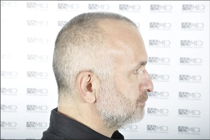 Asmed Clinic - FUE Hair Transplant - 5041 Grafts photo