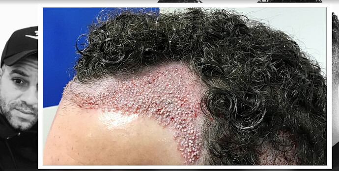 Dr.Bisanga, BHR Clinic 1489 FUE 0 - 5 Months Fast Growth Curly Hair photo