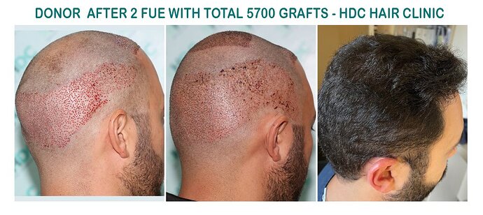 Result of 2 FUE Sessions For Total 5700 grafts - Front and Crown – HDC Hair Clinic photo