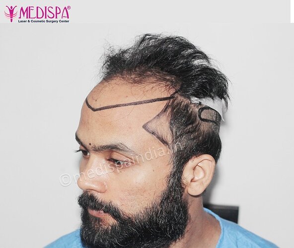 Dr. Suneet Soni - 5320 Grafts, Combine FUT + FUE Technique , NW- IV photo