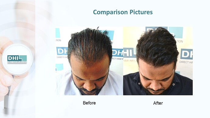 DHI India™ | NW 3 | 4,821 Grafts | 1 year DHI Hair Transplant Results photo