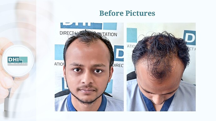 DHI India™ | NW 4 | 4,265 Grafts | 6-Months DHI™ Hair Transplant Results photo
