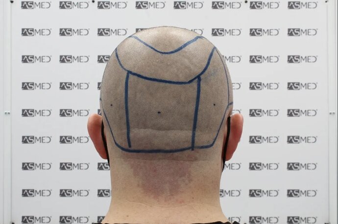 ASMED CLINIC - DR.KORAY - 5060 GRAFTS FUE photo