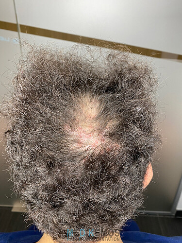 CASE DR. LUPANZULA - MEDIKEMOS CLINIC: 3112 UFS, FUE, FRONT AND MID SCALP photo