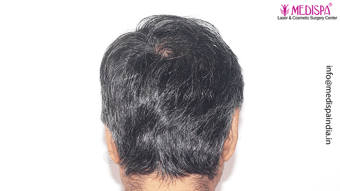 Dr. Suneet Soni - 4889 Grafts | 2.5 Years Result | Combination FUT + FUE + Beard photo