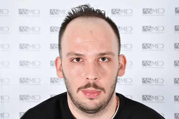 ASMED, Istanbul: 5,071 Manual FUE Grafts 0/12 Months photo