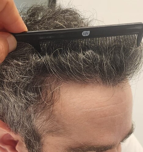 Result of Class 3V Patient – 3530 Grafts – HDC Hair clinic – Dr Maras photo