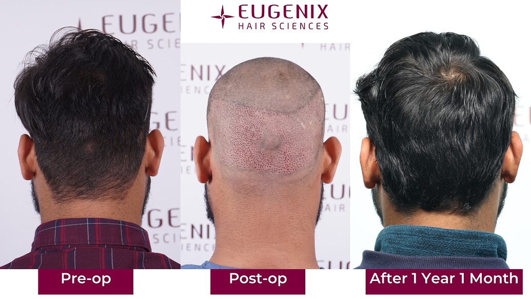 https://cdn.forumhairtransplant.com/optimized/3X/3/c/3c45c9680d0186a4d31a347687a6e74c5f4bf4e4_2_1035x582.jpeg