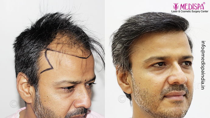 Dr. Suneet Soni - 4889 Grafts | 2.5 Years Result | Combination FUT + FUE + Beard photo