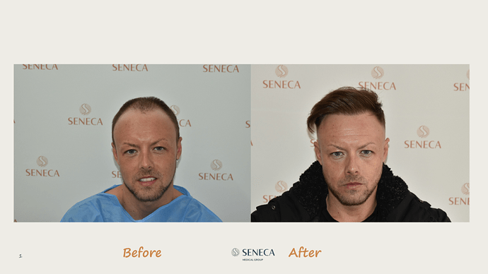 Seneca Medical Group - 3200 grafts with Direct Fue photo