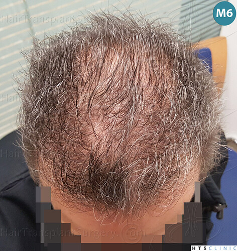 Dr Devroye + Dr Montesanti + Dr Jenard / 7015 grafts (4512 FUT + 2503 FUE) / 2 sessions photo